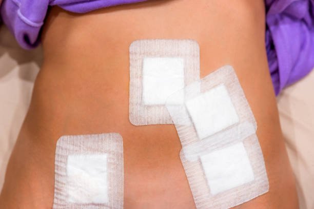 Stitch Removal (Stitch Out) at Home in Lahore