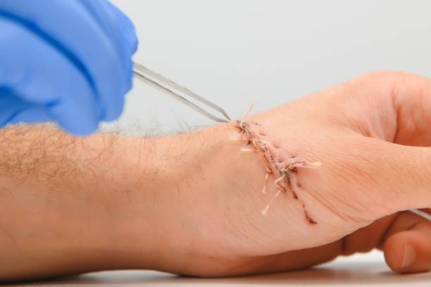 Stitch Removal (Stitch Out) at Home in Lahore