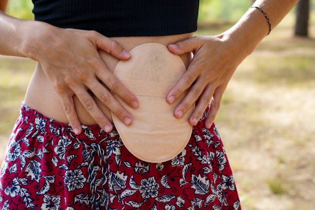 Stoma Bag Care