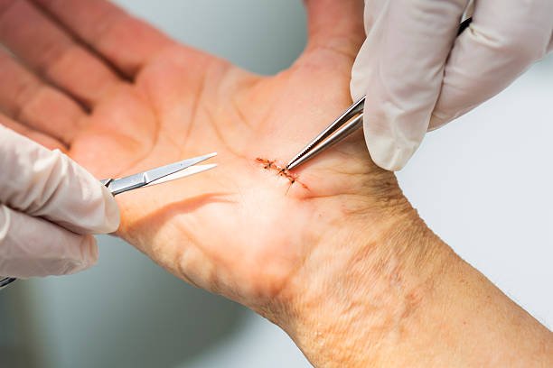 Stitch Removal (Stitch Out) at Home in Lahore